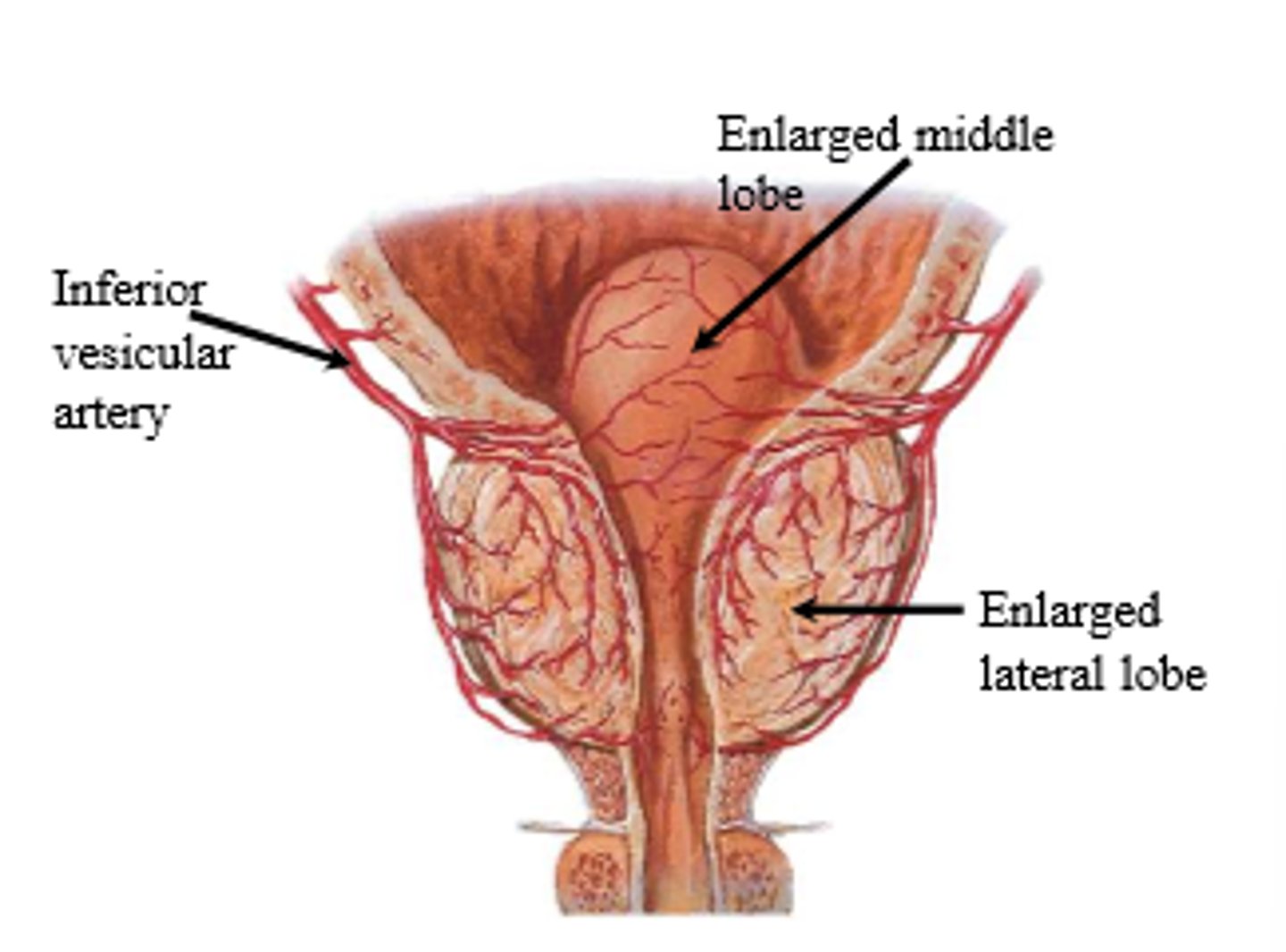 <p>benign growth of cells within the prostate gland</p>