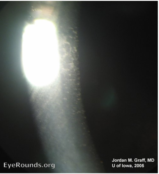 <p>what slit lamp tecnhique is being demonstrated in the image below&nbsp;</p>