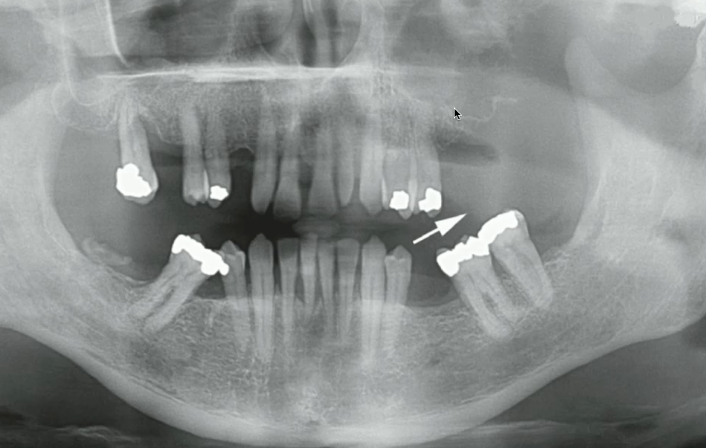 <p>what indicates that this soft tissue mass may be malignant (squamous cell carcinoma) </p>