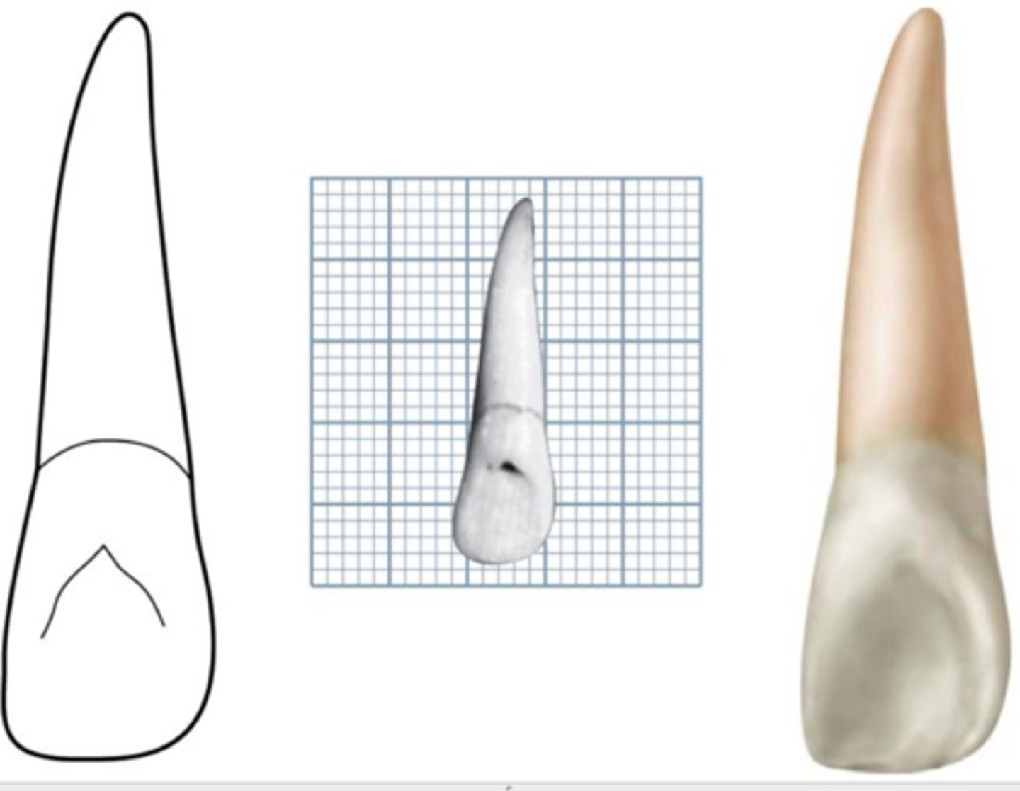 <p>- pretty much same but laterally (distally) shifted</p><p>- incisal edge slopes distally</p><p>- cingulum twisted distally</p><p>- root apex curved distally</p><p>ONLY TOOTH WITH PALATAL PIT (pinpoint depression)</p>