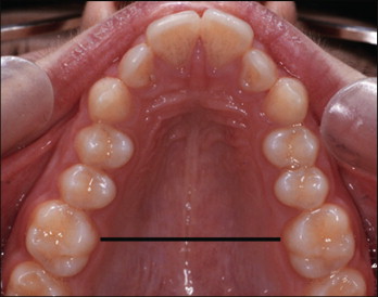 <p>Upper Arch- Not capable of movement and fixed to the skull</p>