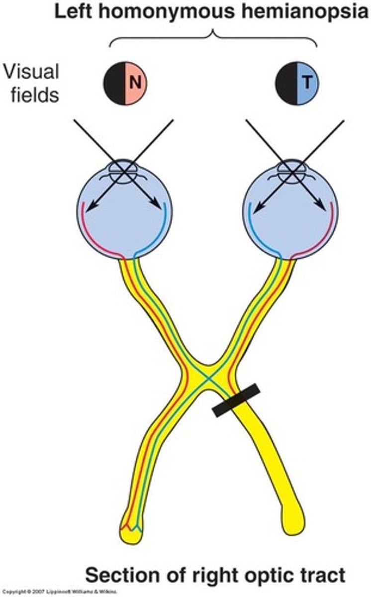 <p>Results in:</p><p>-CL motor and sensory loss involving UE and Face (UE>LE)</p><p>-CL homonymous hemianopsia</p><p>-If L CVA = aphasia</p><p>-If R CVA = perceptual problems (UL neglect, depth perception, spatial relations agnosia, apraxia)</p>