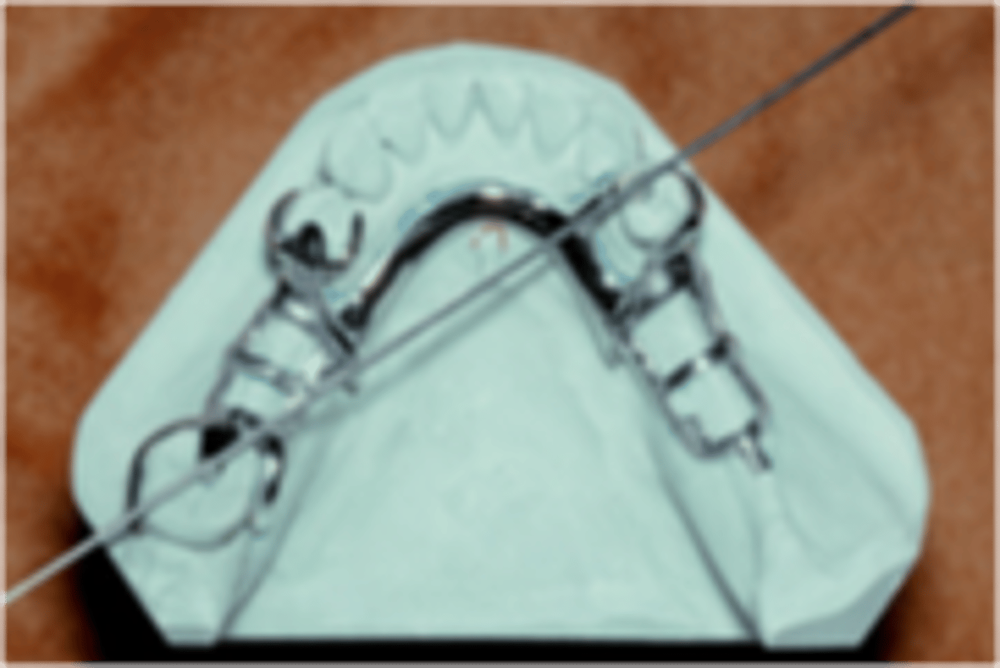 <p>indirect retainer type</p>