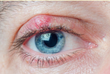 <p>Blockage of the Meibomian gland duct with a chronic granulomatous inflammatory lesion - usually caused by non infection MG occlusion </p><ul><li><p>Painless lid lump, usually single, may be recurrent, may rupture</p></li><li><p>occasionally blurred vision from induced astigmatism</p></li></ul><p></p>