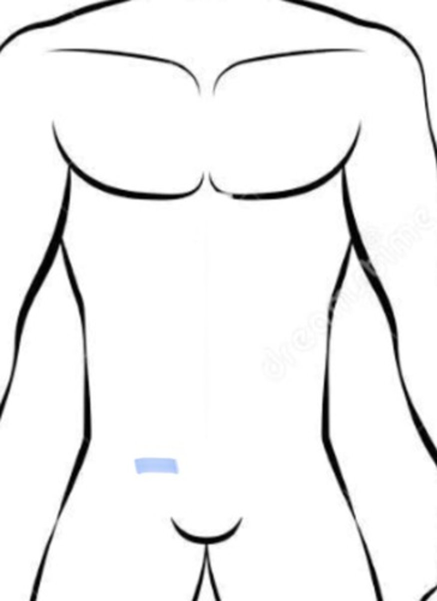<p>what incision is this</p>