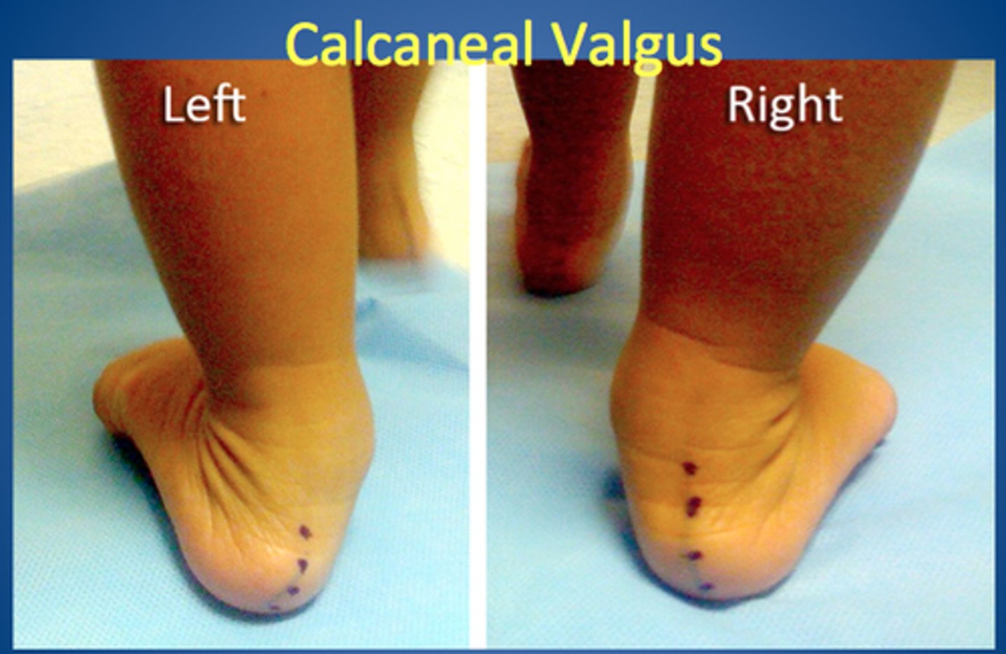 <p>most common, foot sharply angled at the heel and pointing up and outward</p>