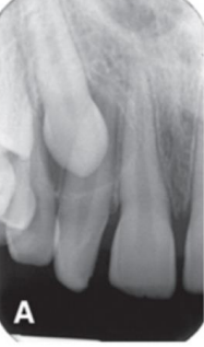 <p>in the right angle technique, the periapical localizes in the</p>