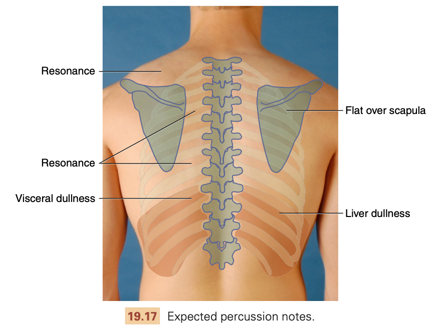 <ul><li><p><strong>Resonance:</strong>&nbsp;Low pitched, clear hallow normal sound over healthy lung tissue.</p></li><li><p><strong>Dullness: </strong>Soft muffled thud, &nbsp;Indicates fluid or solid mass (e.g., pleural effusion, clavicle).</p></li><li><p><strong>Hyperresonance:</strong>&nbsp;Lower pitch booming sound, Indicates air trapping (e.g., pneumothorax).</p></li><li><p><strong>Tympany:</strong>&nbsp;Indicates air-filled space (e.g., stomach).</p></li></ul><p></p>