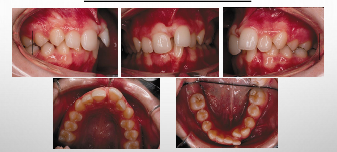 <p>-a normal molar relationship exists but there is crowding, misalignment of the teeth, crossbites, etc.</p>