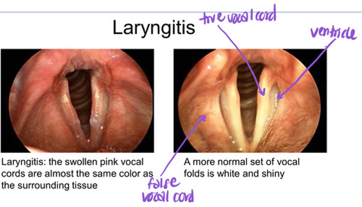 <p>swollen pink vocal cords due to viral/bacterial infection, excessive use of voice, smoking, excessive alcohol consumption, laryngeal trauma (vocal cords shouldn't be as pink as the surrounding tissue) </p><p>  -<span style="text-decoration:underline">symptoms</span> ==&gt; hoarseness, dry/burning throat, coughing, difficulty swallowing</p><p></p>