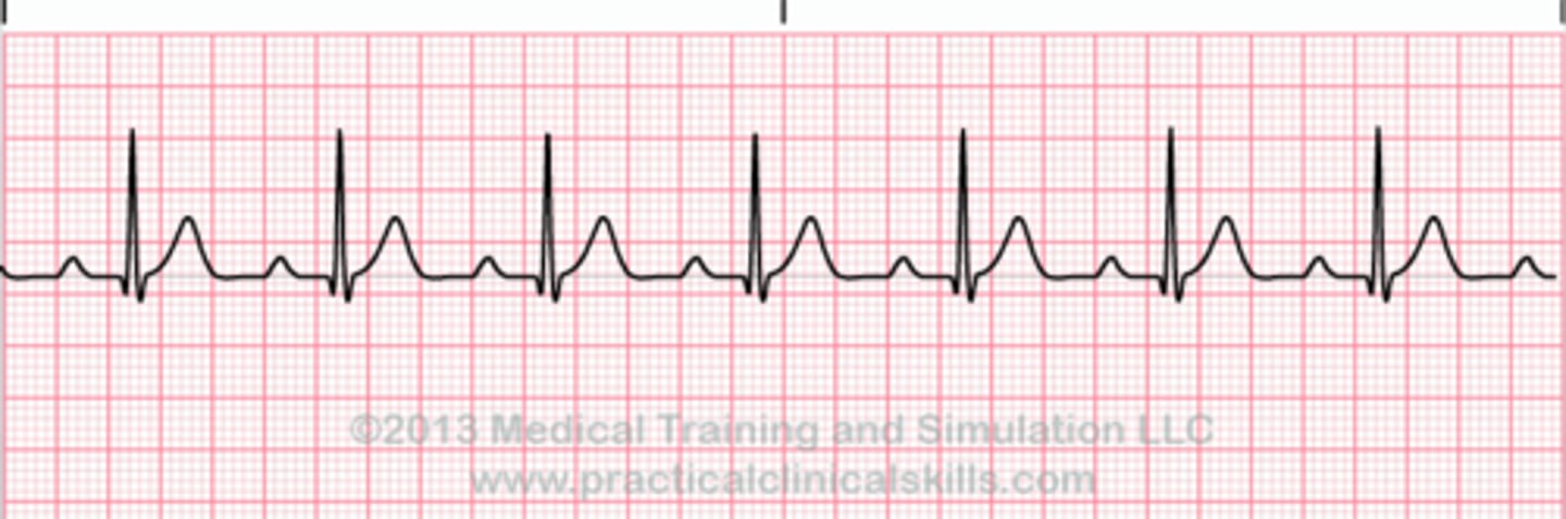 <p>atrial conduction delayed through AV node, prolonged PR interval</p><p>rate: depends on underlying rhythm</p><p>rhythm: regular</p><p>P waves: present before each QRS, consistent in size and shape</p><p>PR interval: &gt;0.20 seconds</p><p>QRS duration: &lt;0.10 seconds</p>