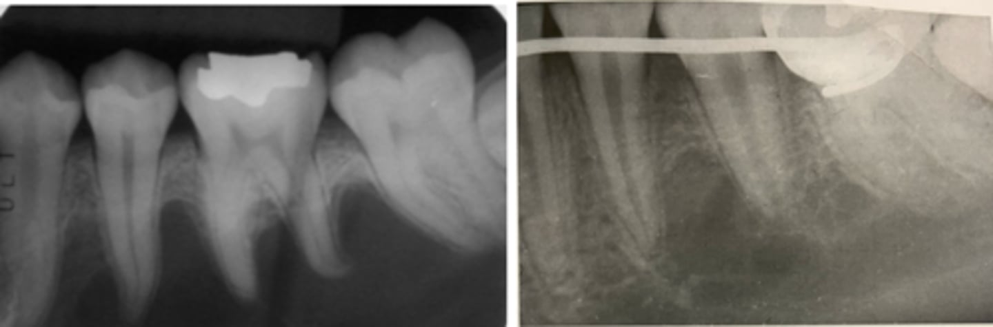 <p>Traumatic bone cyst</p><p>Scalloping around the roots is a term often used to describe the radiographic appearance of a traumatic bone cyst. </p><p>A Stafne bone cyst usually presents as an oval radiolucency anterior to the angle of the ramus and inferior to the mandibular canal. </p><p>A lingual mandibular bone concavity is the same lesion as a Stafne bone cyst. </p><p>A median palatine cyst is a developmental cyst that presents as a unilocular radiolucency found in the midline of the hard palate.</p>