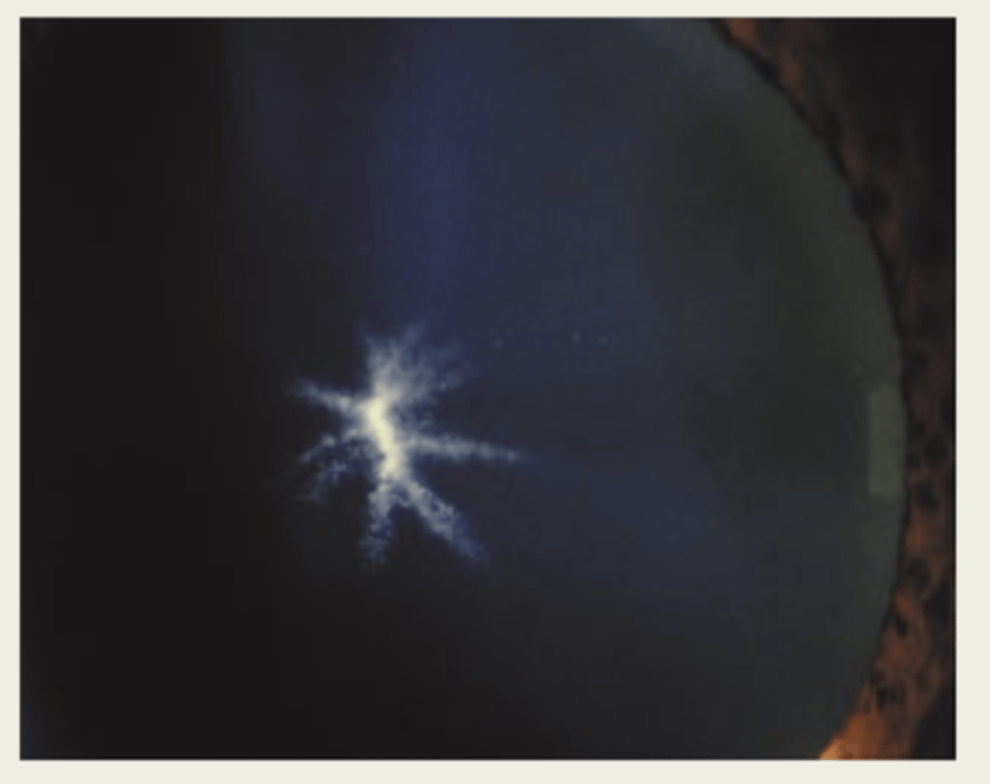 <p>medication induced cataract</p>