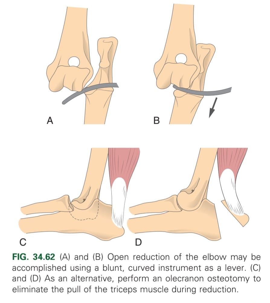 <p>Incise &amp; reduce, &amp; flush joint afterwards. NB: check stability.</p>