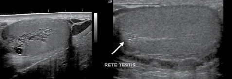 <p>tubular ectasia of rete testis</p>