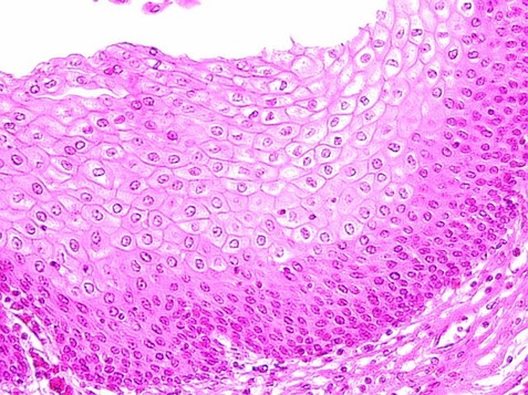 <p>Stratified Squamous (Epithelial) </p>