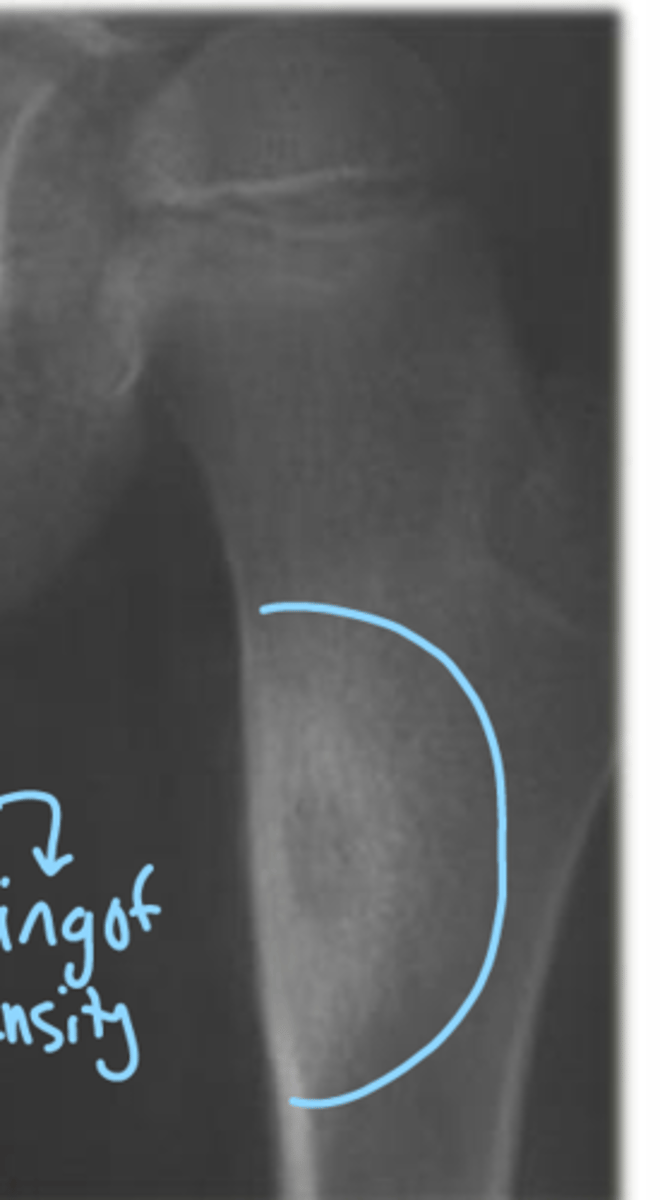 <p>osteoid osteoma</p>