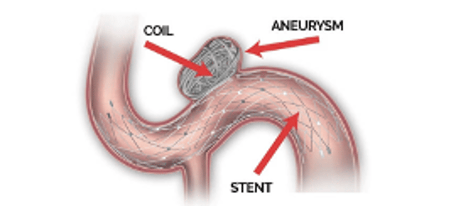 <p>Endovascular Coiling</p><p>➢Diverts blood flow to decrease stress on vessel wall</p><p>➢Less invasive</p><p>➢Wide neck aneurysms require stent and DAPT</p>