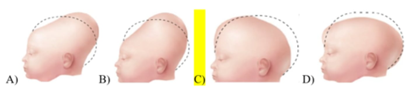 <p>36) A fetus has a brow cephalic presentation. Which head shape should the nurse expect when the infant is delivered?</p>