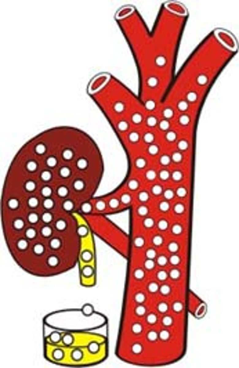 <p>glucose in urine - happens when blood glucose levels exceed the kidney's reabsorption capacity - eg. hyperglycemia</p>