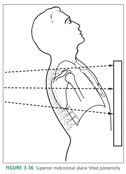 <p>Superior midcoronal tilt posteriorly </p>