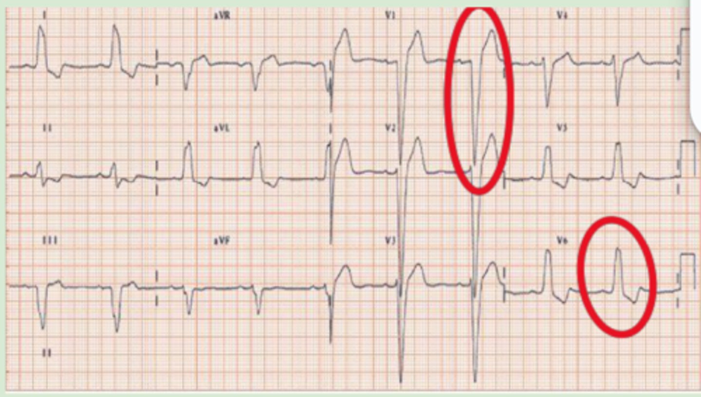 <p>QRS = &gt;0.12 seconds</p><p>Primarily V1 but also V2-V3</p><p>-Deep S waves</p><p>V5-V6</p><p>-Tall R waves</p>