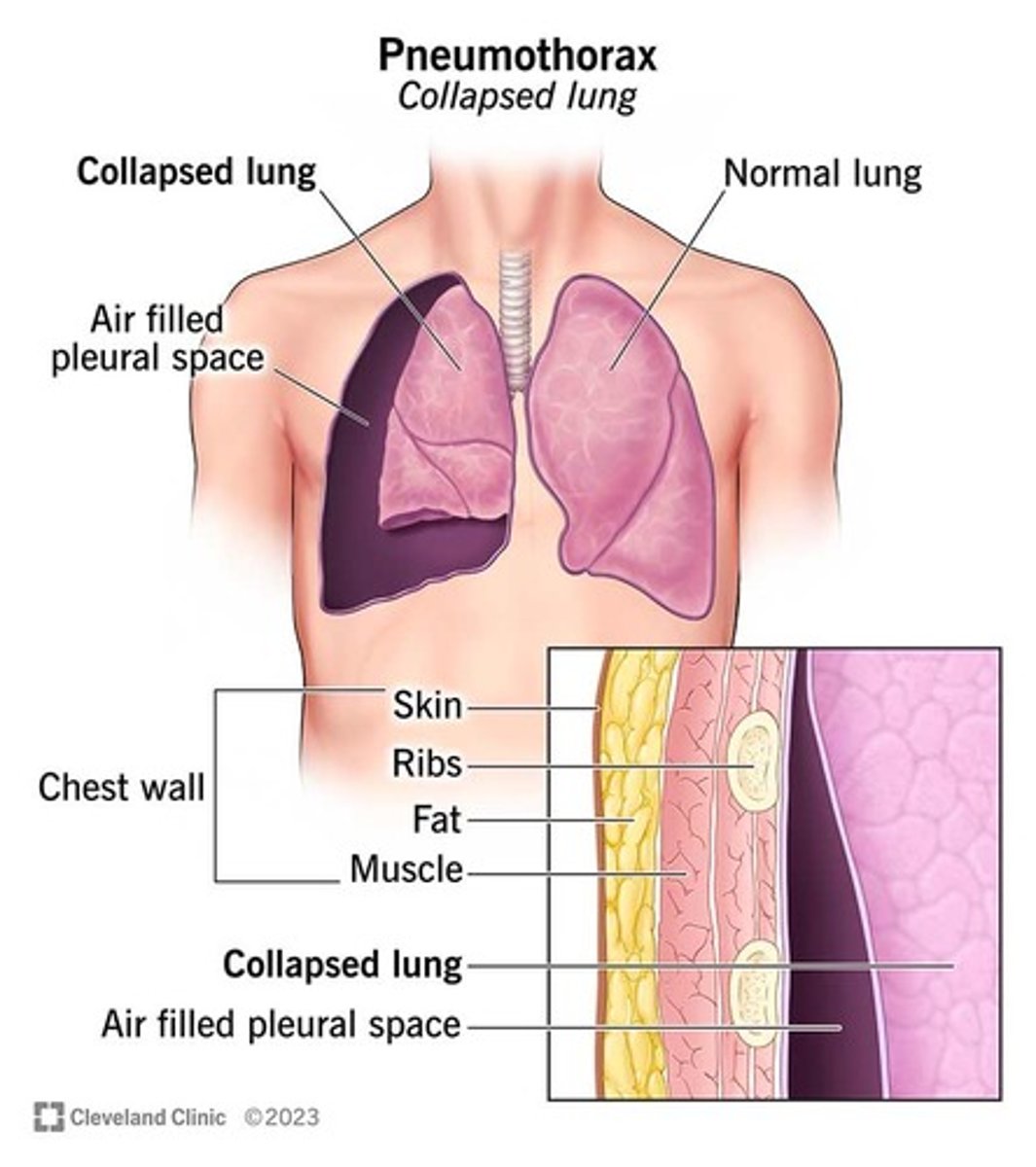 <p>- air in the pleural space, compressing the lung as a result</p><p>- many classifications: tension vs pneumothorax</p><p>=> tension pneumo is an emergency!</p>