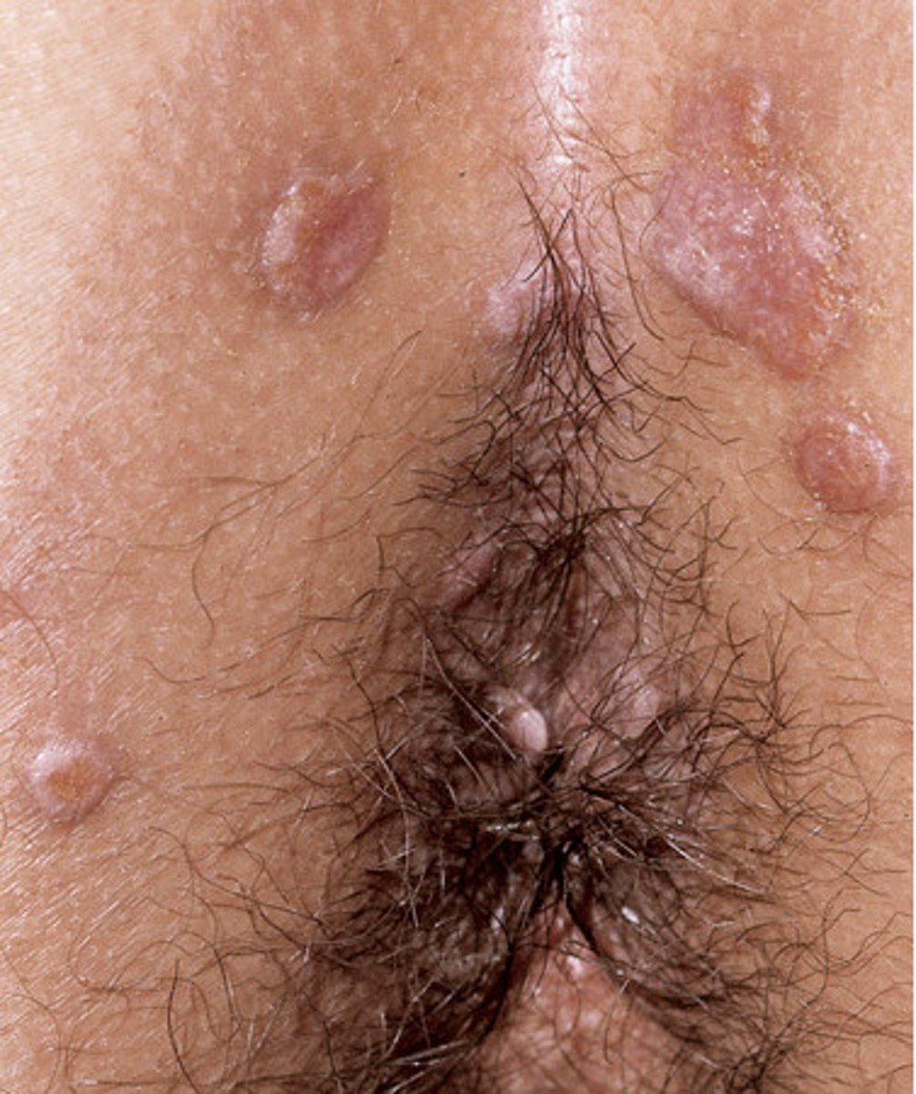<p>Condylomata lata (secondary syphilis)</p>