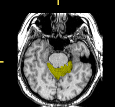 <p>What part of the brain is highlighted?</p>