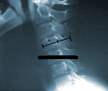 <p>ratio of the spinal canal diameter to the vertebral body diameter</p>
