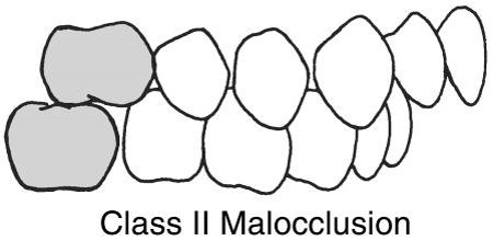 <p>Class II Malocclusion</p>