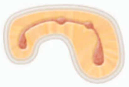 <p><span>a </span><span style="color: red;"><span>complete or incomplete</span></span><span> isthmus between </span><span style="color: red;"><span>three or more canals</span></span></p>