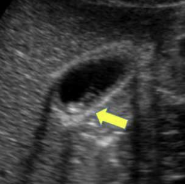<p>contracted GB with stone</p><ul><li><p>Wall- linear anterior wall of GB</p></li><li><p>Echo- echogenic gallstone</p></li><li><p>Shadow- posterior to gall stone </p></li></ul>