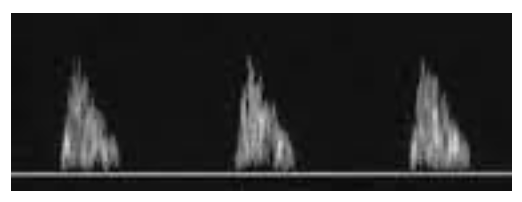 <p>Indirect indications of the presence of disease</p><p>If this waveform is found in the CCA where is the occlusion?</p>