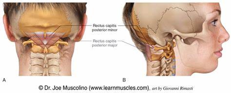 <p>O- posterior tubercle of posterior arch of C1</p><p>I- Inferior nuchal line</p><p>A- Extend neck</p><p>I- suboccipital nerve (posterior rami of C1) (Same as Major and Obliquus capitis inferior/superior)</p>