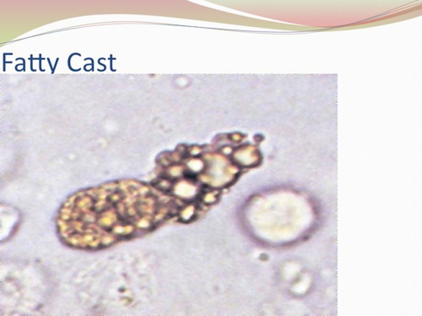 <p>Are seen in conjunction with oval fat bodies and free fat droplets in disorders causing lipiduria.</p><p>- Examples: nephrotic syndrome, toxic tubular necrosis, diabetes mellitus or crush injuries</p><p>- They are highly refractile under bright-field microscopy.</p><p>- The matrix may contain attached fat droplets or oval fat cells on the outside</p>