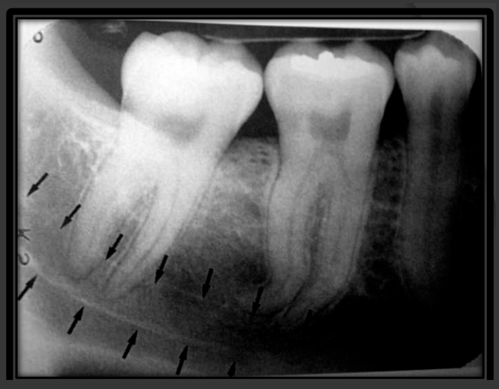 <p>It is a radiolucencent band that follows the contour of the mandible that runs under the teeth.</p>