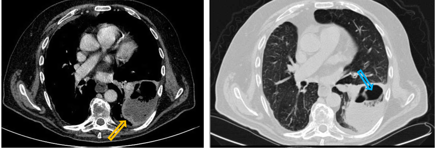 <p>Patient history: chest pain, cough and fatigue in an immunocompromised patient</p><p>Modality: Contrast-enhanced chest CT, lung window setting (right panel); mediastinal window setting (left panel), iv. iodine-based contrast agent </p><p> Region: chest, axial views</p><p>Radiologic sign: air-containing (blue arrow) fluid collection with thick enhancing rim (yellow arrow) </p><p>Diagnosis: left-sided lung abscess</p>