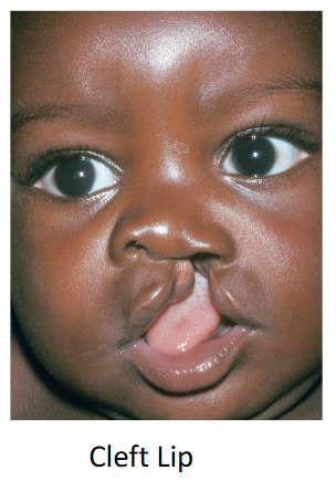 <p>Incomplete fusion of medial and lateral nasal prominences and the maxillary process results in a split in the upper lip. </p>
