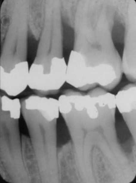 <p>Vertical Bone Loss Examples</p>