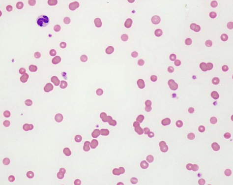 <p>anemia of chronic disease</p>