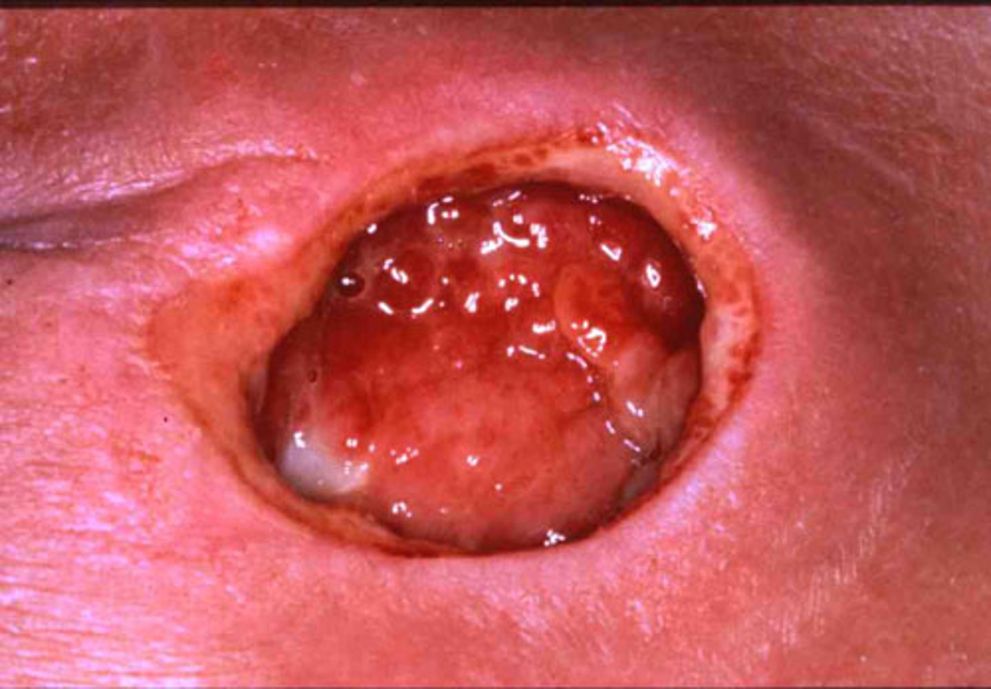 <p>Full-thickness skin loss with damage to or necrosis of the subcutaneous tissue that may extend to but not through the muscle</p>