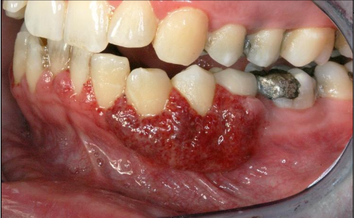 <p>(2%) Strawberry gingiva is red, friable, granular gingiva, non-</p><p>specific ulcer</p>
