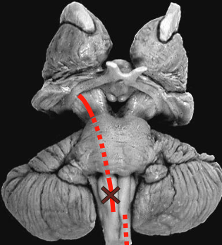 <ul><li><p>Monkeys with lesions to the pyramids, after a period of recovery, exhibit almost normal movement, except for loss of control of individual fingers (motor cortex → spinal cord severed)</p></li><li><p>The monkeys could still move because the corticobulbar doesn’t pass through the pyramids (motor cortex → brainstem → spinal cord not severed, rubrospinal tract allows them to move)</p></li></ul><p></p>
