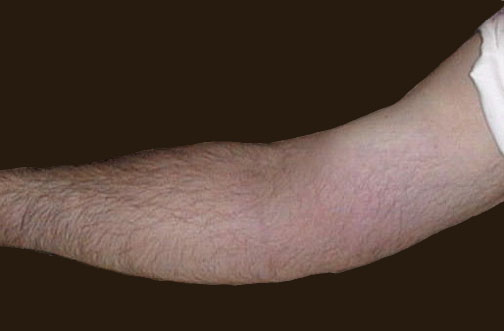 <ol><li><p>What are the cardinal signs of inflammation?</p></li><li><p>What could cause involving the light lower arm?</p></li></ol>