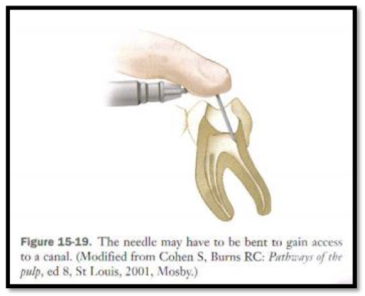 <p>injection directly into the pulp chamber or root of tooth after exposure surgically or pathologically</p>