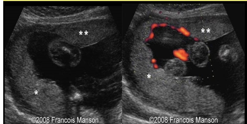 <p>which is described as ectopic lobes of placenta tissue separate from the main placenta</p><p>a) placenta previa</p><p>b) placenta accreta</p><p>c) succenturiate placenta</p><p>d) placenta increta </p>