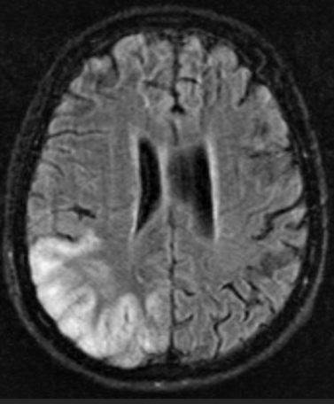 <p><strong>Stroke in her right brain first, then her left - caused paralysis of arms and difficulty seeing/hearing</strong></p><ul><li><p>14 yo Vietnamese girl at school had a seizure, and on arrival in ER could not move her right arm or see to her left. On exam, she was quite short and thin, and hard of hearing. A month later she was back in ER, this time unable to move her left arm, and her hearing was worse.</p></li></ul><p></p>