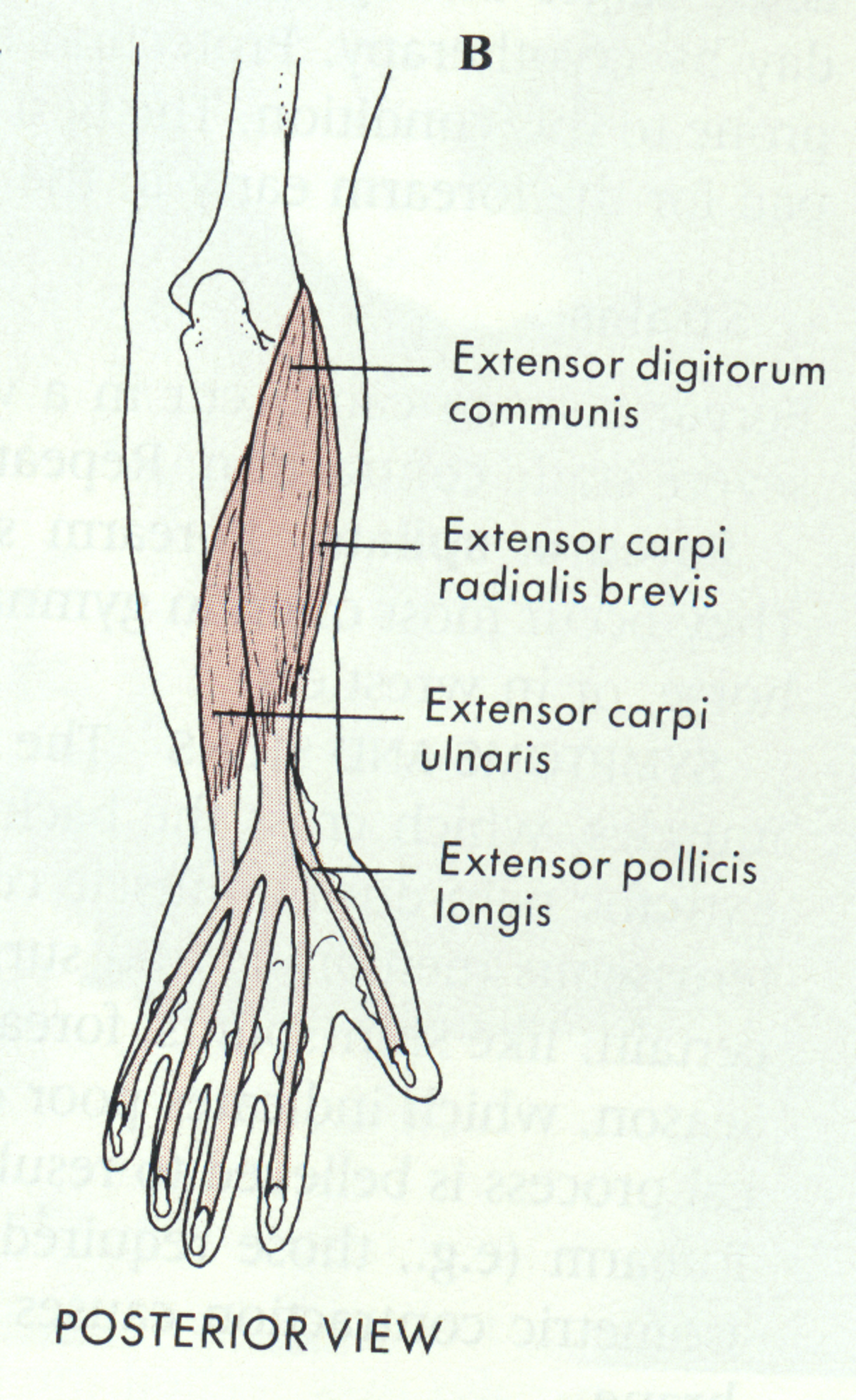 <p>-All originate off L. epicondyle via common extensor tendon</p><ul><li><p>ECRB</p></li><li><p>EDC</p></li><li><p>ECU</p></li><li><p>EDM</p></li><li><p>ECRL: O → Humerus, I → 2nd MC</p></li></ul>