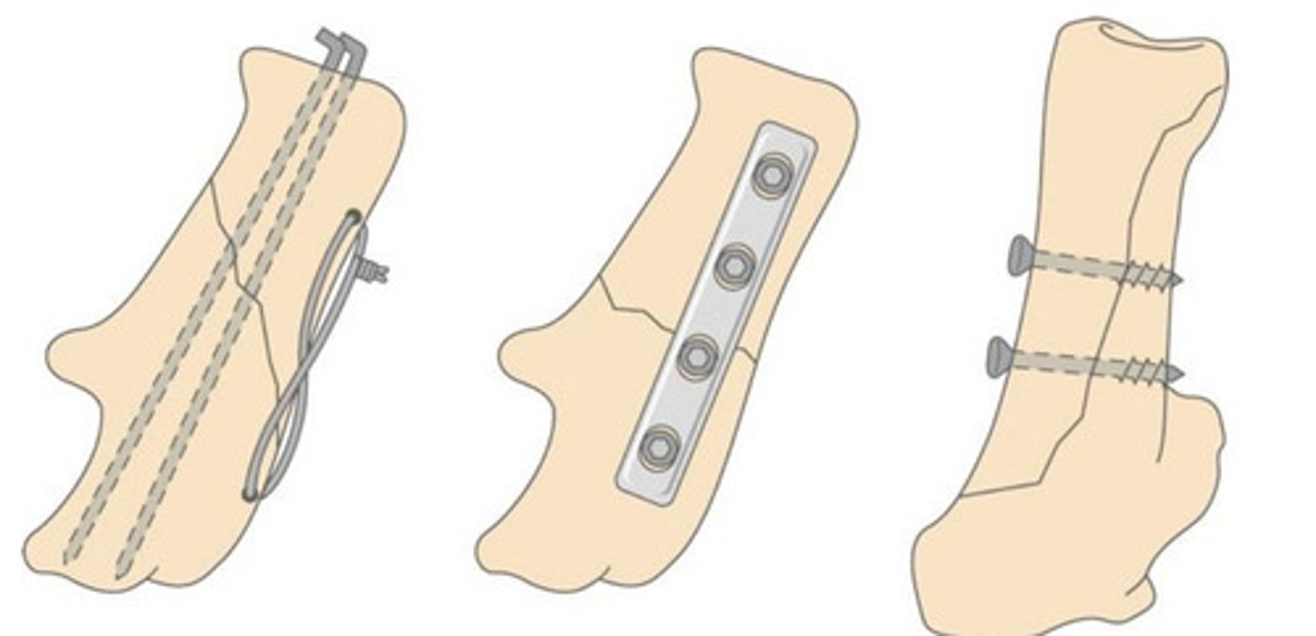 <p>What is happening here? Describe each of the fractures and the treatment.</p>